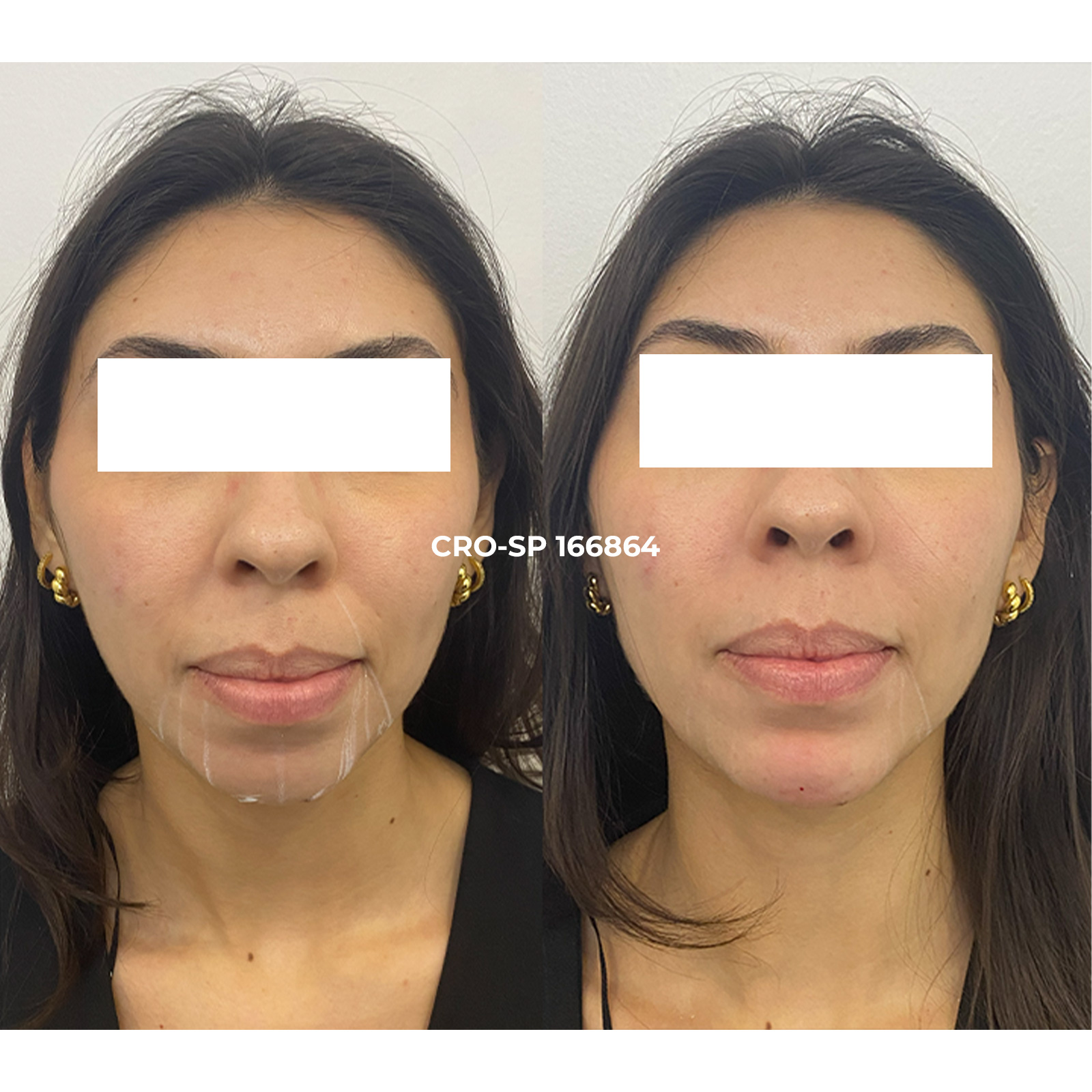 Resultado harmonização orofacial Campolim