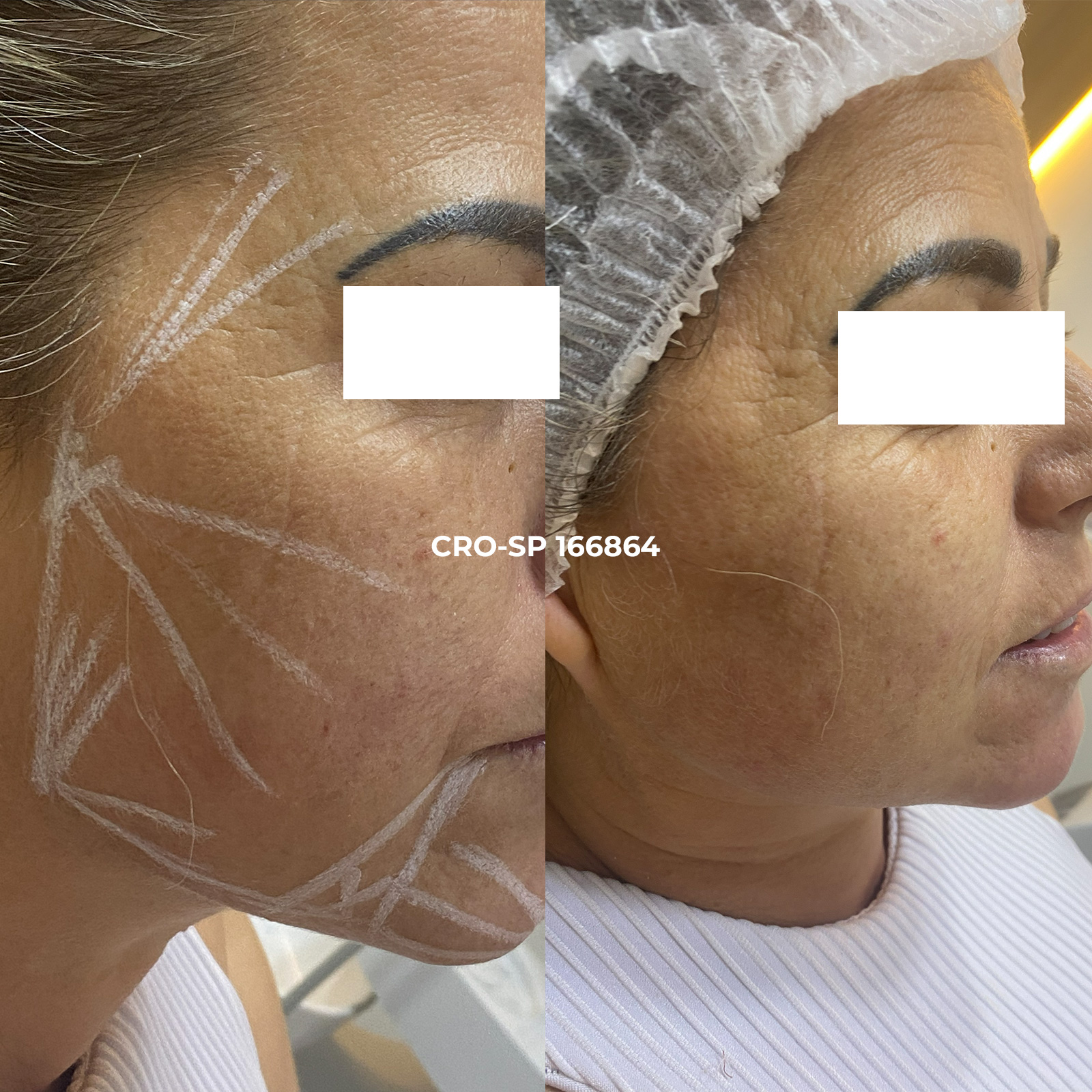 Resultado tratamento facial Dra Laís Sorocaba